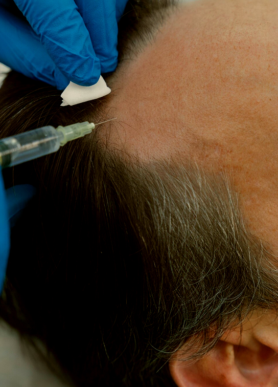 Hair Restoration Prp Aftercare Recovery Img