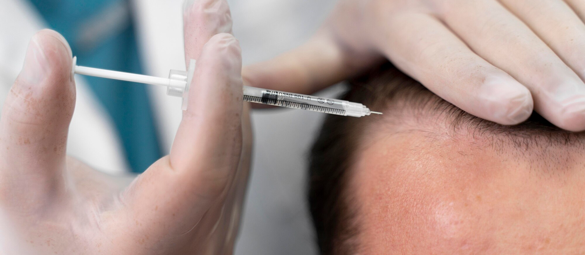 Services Hair Restoration Prp Feature Img